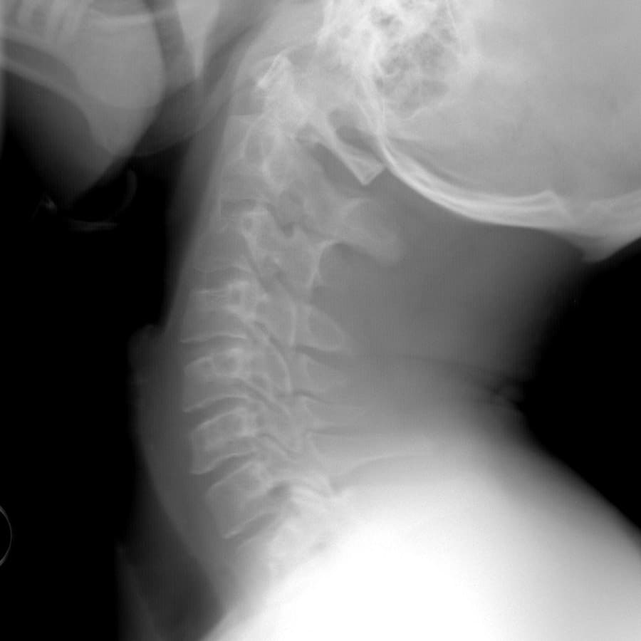 cervicale 03